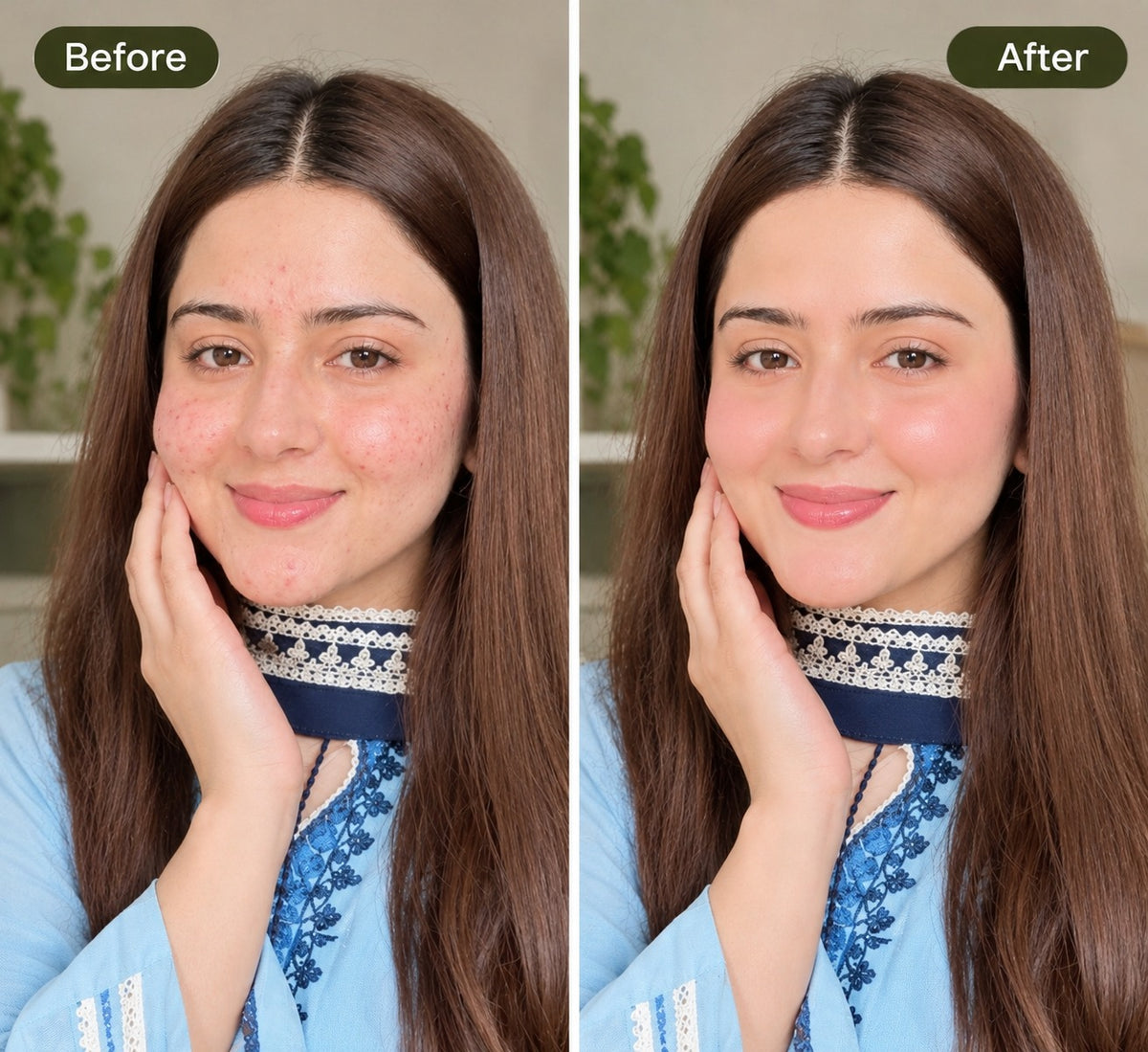 NAAD Derma Acne Killer Bundle