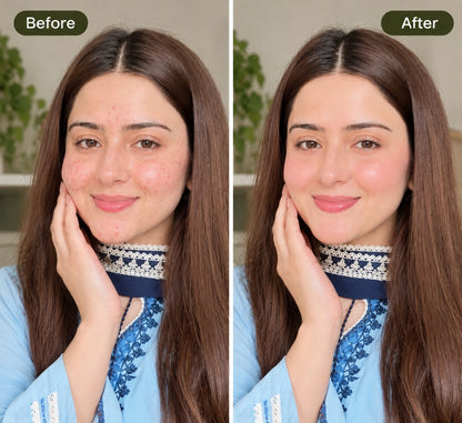 NAAD Derma Acne Killer Bundle